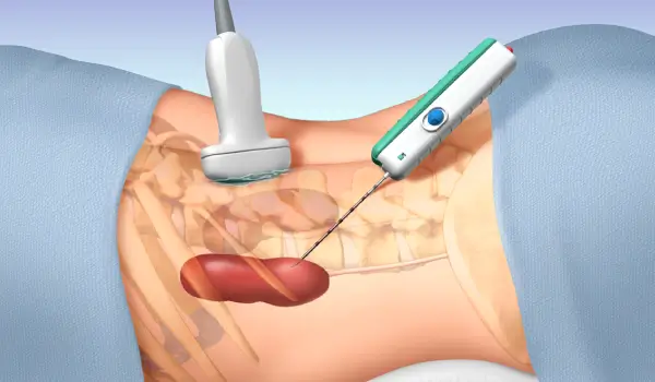  Precio de Consulta de Biopsia renal en Culiacán, Sinaloa